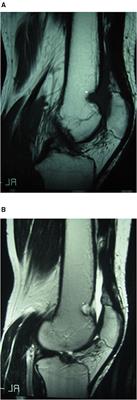 Location, Clinical Presentation, Diagnostic Algorithm and Open vs. Arthroscopic Surgery of Knee Synovial Haemangioma: A Report of Four Cases and a Literature Review